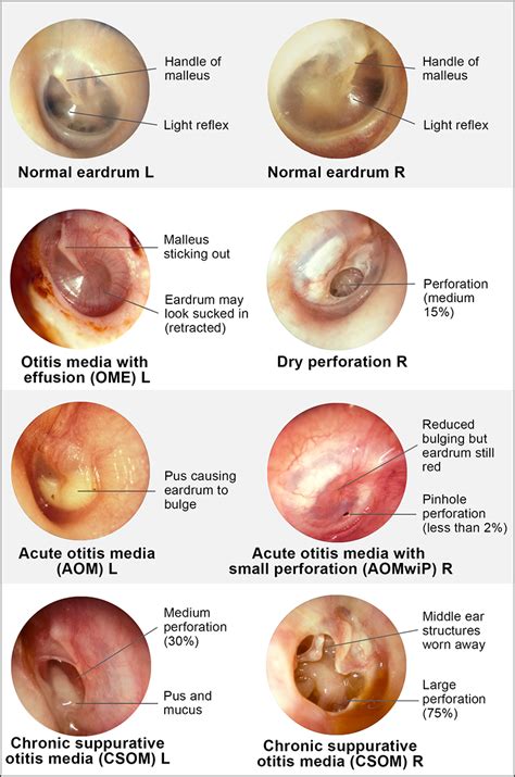 Normal Tympanic Membrane Vs Bulging