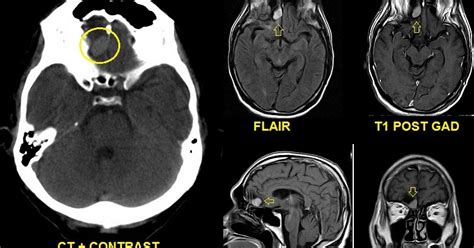 POINT OF VIEW: DX: Olfactory groove meningioma