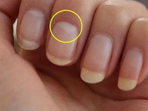 Symbol of Nails Double Colored Liver Diseases