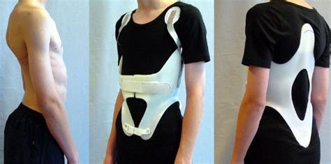 Kyphologic Brace | Kyphosis | Brace | Scheuermanns | Kyphoscoliosis