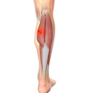 Gastrocnemius Strain