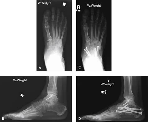 Triple Arthrodesis | Plastic Surgery Key