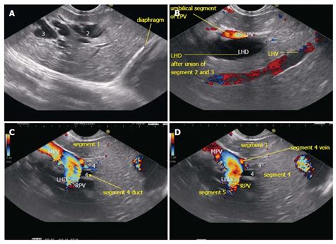 Common Hepatic Duct Ultrasound