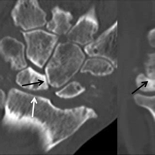 (PDF) Scapholunate advanced collapse: a pictorial review