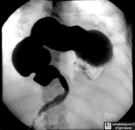 LearningRadiology - Gastric Volvulus, Organoaxial, Mesenteroaxial