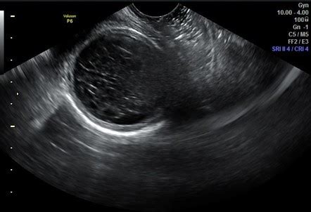 Hemorrhagic ovarian cyst | Radiology Reference Article | Radiopaedia.org