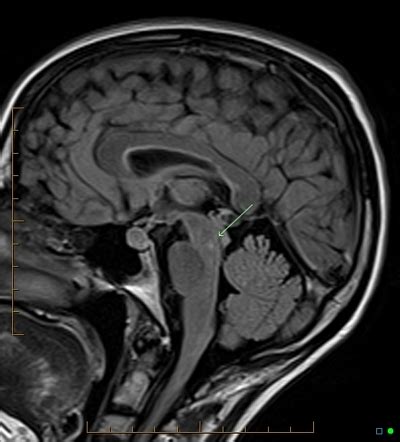 Internuclear Ophthalmoplegia Mri