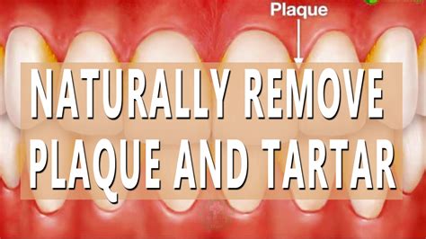 If You Want To Naturally Remove Plaque And Tartar These Are The Most Useful Home Remedies For ...