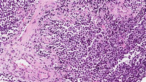 Rhabdomyosarcoma - MyPathologyReport.ca