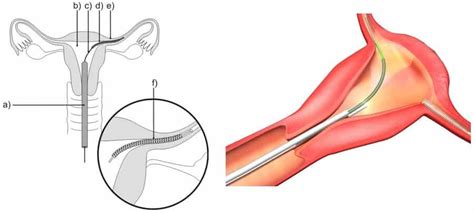 Essure Birth Control Lawsuit & Recall September 2024 - Select Justice