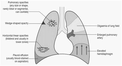 Pulmonary Embolism : Chest X-ray Signs | Epomedicine