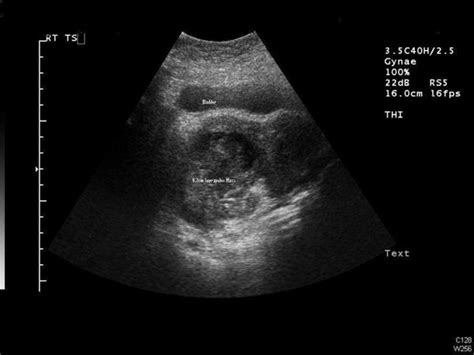 Appendicular mass mimicking as suprapubic mass: a case report | Cases Journal | Full Text