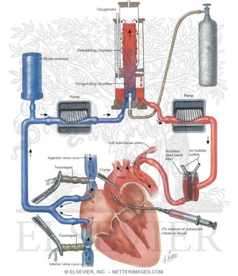 Heart-Lung Machine