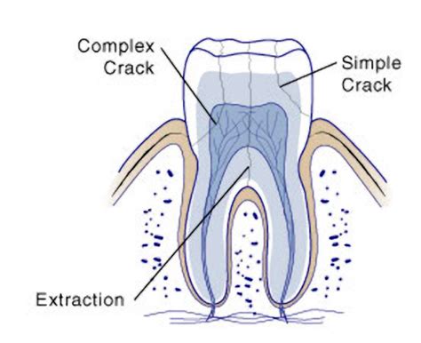 Procedure For Cracked Molar