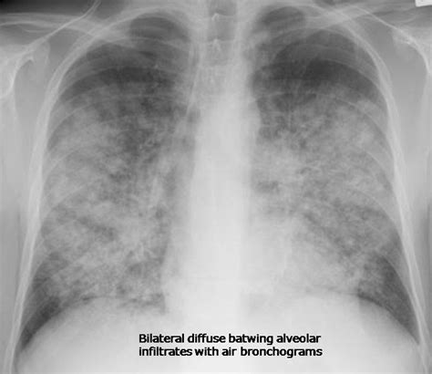 RadiologySpirit: CHF with alveolar edema