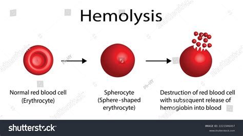 Hemolysis Normal Red Blood Cell Spherocyte Stock Vector (Royalty Free ...