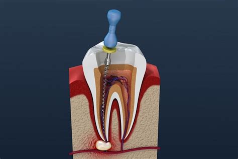 Step-by-step Guide to a Root Canal Procedure - Hudson Family Dental Grand Junction Colorado