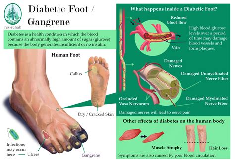 Diabetic Foot Syndrome Gangrene Of The Big Toe Amputation Of The Big | My XXX Hot Girl