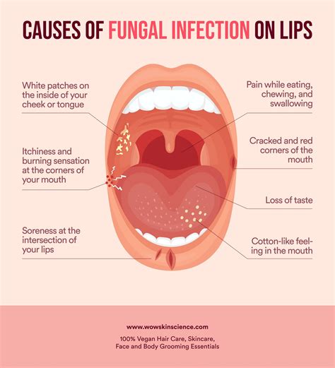 Fungal Infection On Lips, Its Causes And How To Treat It