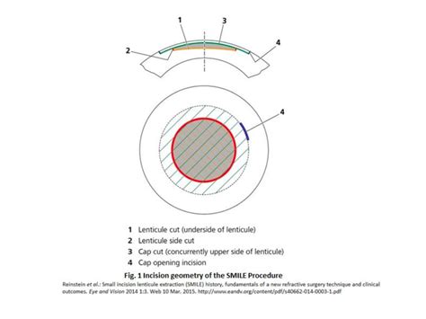 LASIK vs SMILE: Choosing the Best Corrective Surgery Tech