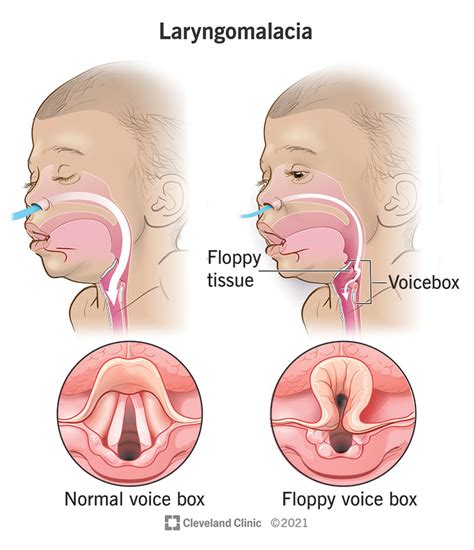 Swollen Epiglottis Treatment