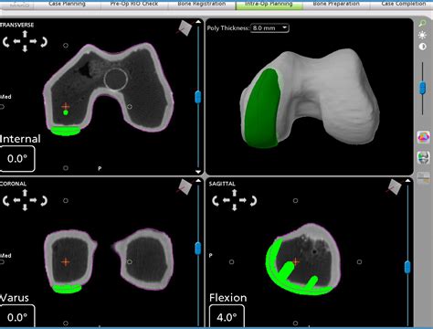 Mako Robotic Arm Assisted Partial Knee | Stryker Orthopaedics UK