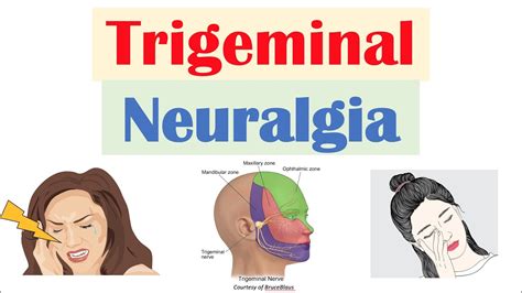 Trigeminal Neuralgia Causes In Hindi - mapasgmaes