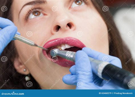 Close-up Medical Dentist Procedure of Teeth Polish Stock Image - Image ...