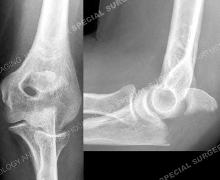 Ulna Fractures - Orthopedic Trauma Service