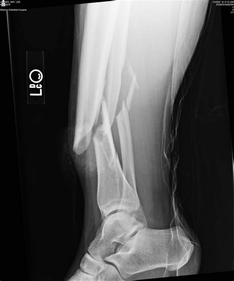 image9 | compound open tib fib fracture 1-4-07 | Amy A | Flickr