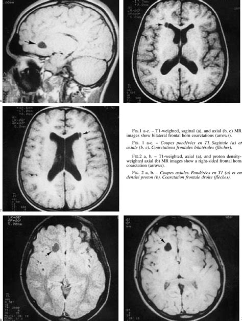 Figure 2 from MRI AND ASYMPTOMATIC COARCTATION OF THE FRONTAL LATERAL ...