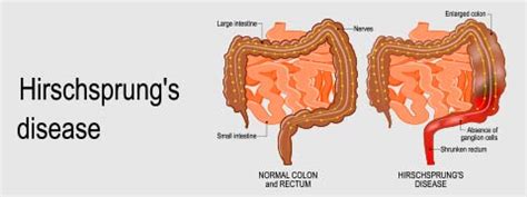 Hirschsprung Disease: Causes, Symptoms And Treatment | Netmeds