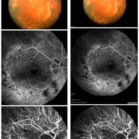 Typical fundus photographs of myopia patients before and after surgery. | Download Scientific ...