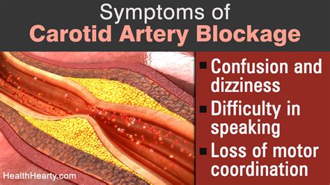 Signs Of Carotid Artery Blockage