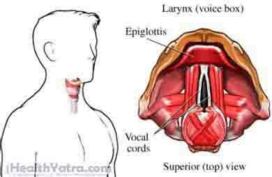 Laryngitis Definition, Causes, Symptoms, Complications and Cost Surgery ...