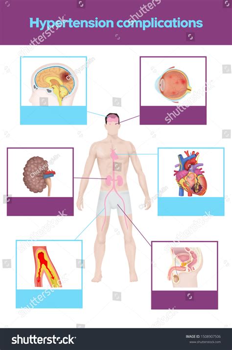 Medical Illustration Explain Hypertension Complications Stock ...