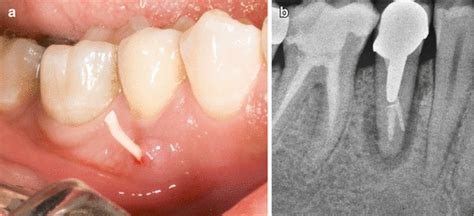 Diagnosis of Vertical Root Fractures | Pocket Dentistry