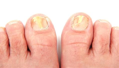 Damaged Toenails - Feet in Focus