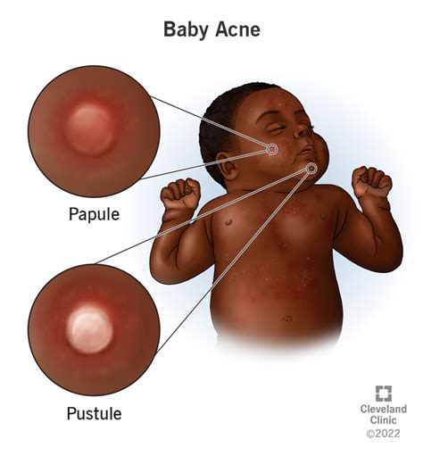 Baby Acne: Causes & Treatments