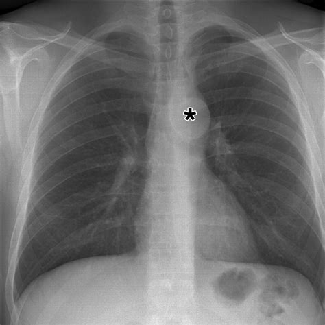 Flail Chest X Ray