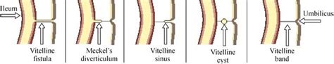 Diagrams showing vitelline duct's remnants. | Download Scientific Diagram