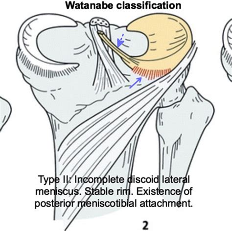 MRI images of the discoid meniscus of the right knee in the 13-year-old... | Download Scientific ...