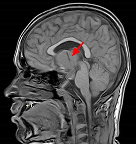 Craniopharyngioma types, causes, symptoms, diagnosis, treatment & prognosis