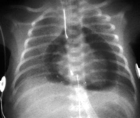 Cardiac Tamponade