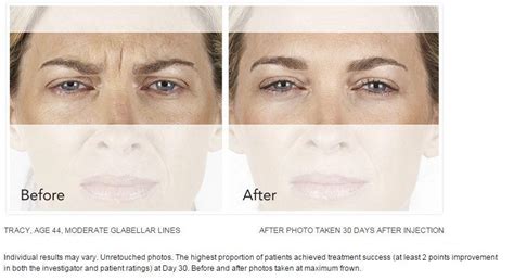 XEOMIN Injections Can Help Reduce Frown Lines: Lounge of Beauty Medical Spa: Medical Spa