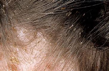 Head Lice | Oblique Hair Spa