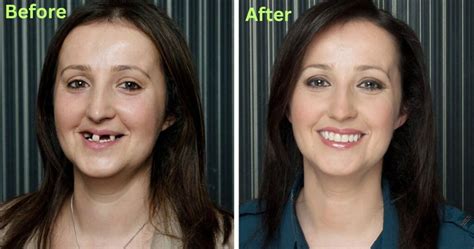 Before and After Dentures: Regaining Your Smile and Confidence - Smile ...