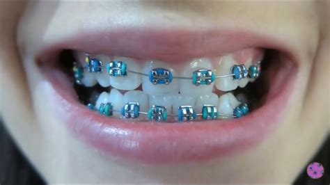 Pin su Braces | Denti, Unghie