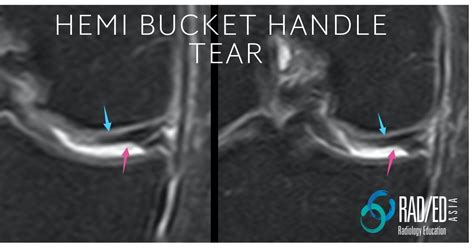 Hemi Bucket Handle Tear Knee MRI - Radedasia