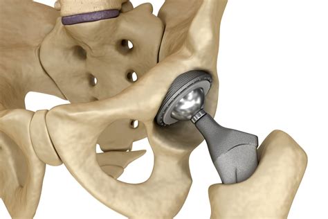 Hip Implants: Complications from Metal-on-Metal Replacements